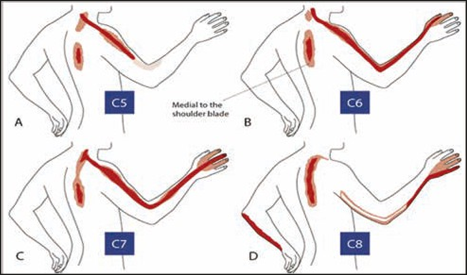 Neck and arm pain symptoms